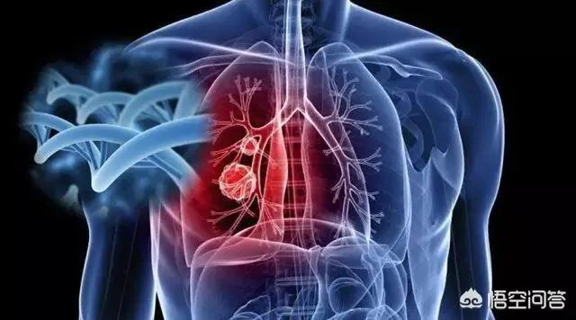 肺癌的的高危人群有哪些？