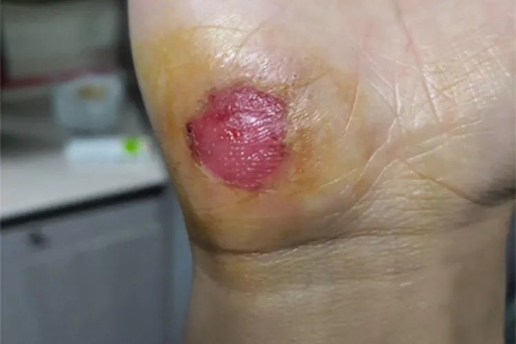 磨压伤缺损图片