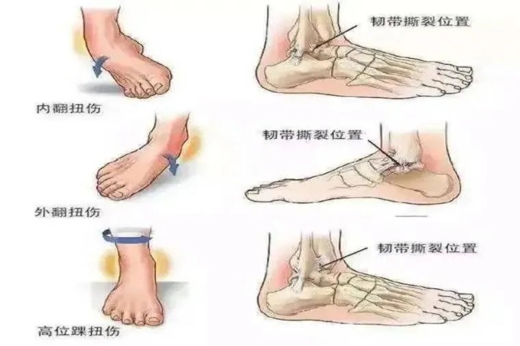 扭伤的准确位置图和作用