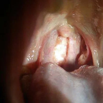 闭塞性细支气管炎能否治愈?