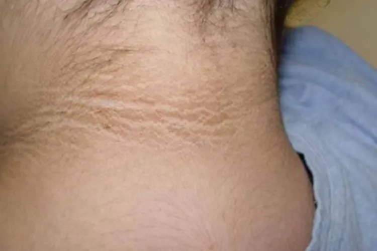黑棘皮病长纹图片