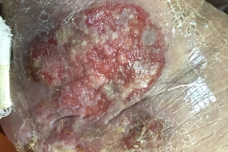 皮肤癌的症状与表现图片