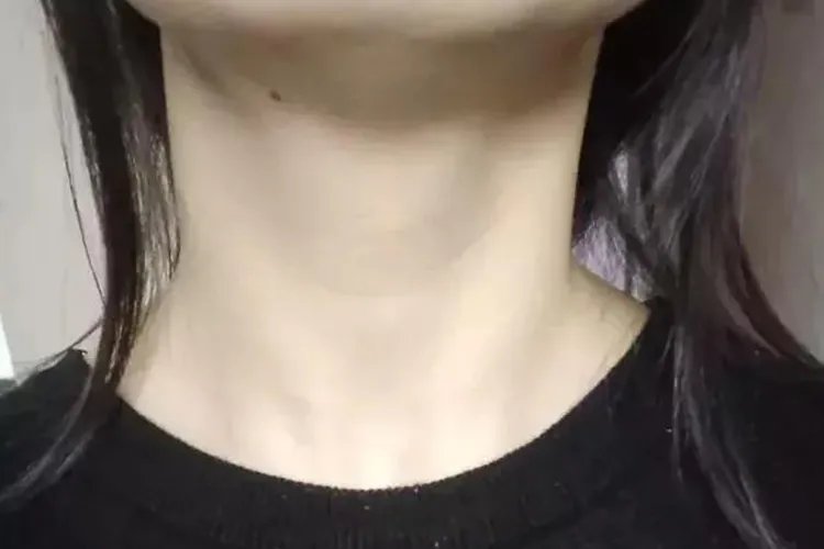 轻微甲状腺肿大图片