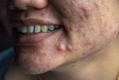 脓疱疮如何预防 盘点脓疱疮的几个预防技巧