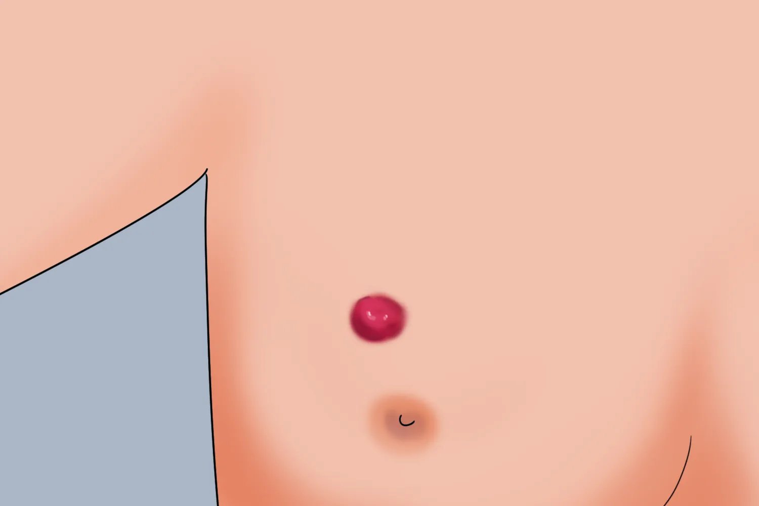 乳房上有个红疙瘩图片