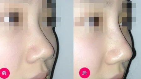 玻尿酸注射隆鼻多少钱呢