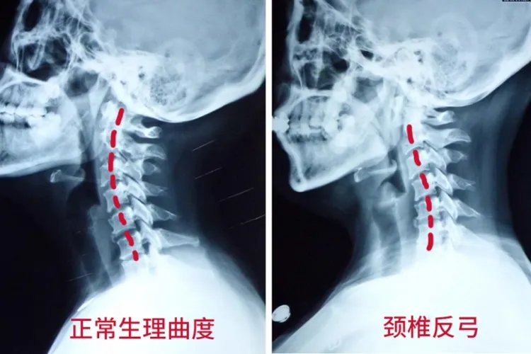 颈椎病会引起哪些不适症状图片