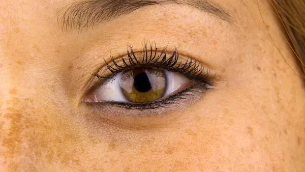 黄褐斑看什么科