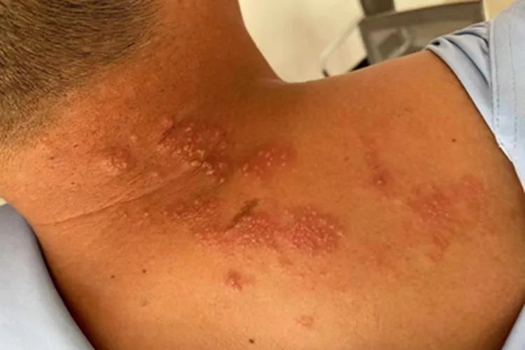 带状疱疹颈部小红疙瘩图片