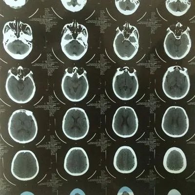 闭塞性细支气管炎能否治愈?