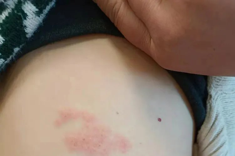 幼儿急疹刚出疹图片