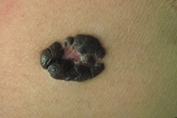 皮肤癌的症状与表现图片