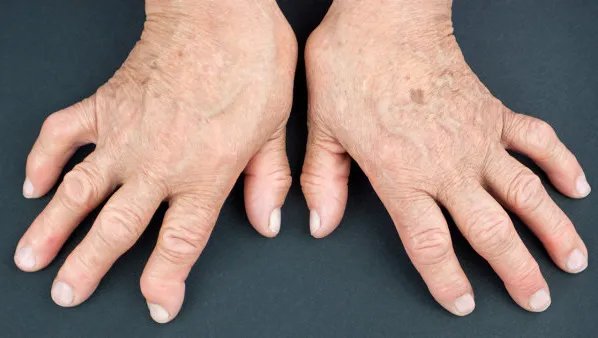 风湿和类风湿的区别