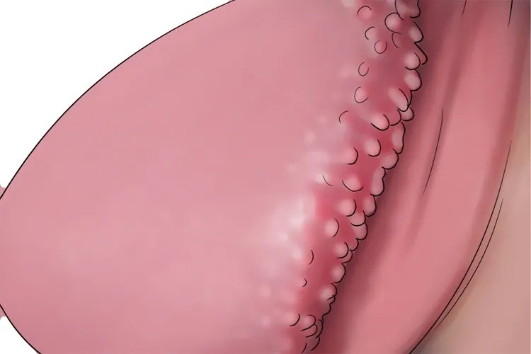 珍珠丘疹症状高清图片