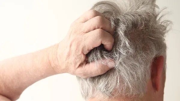 雄激素性脱发的原因