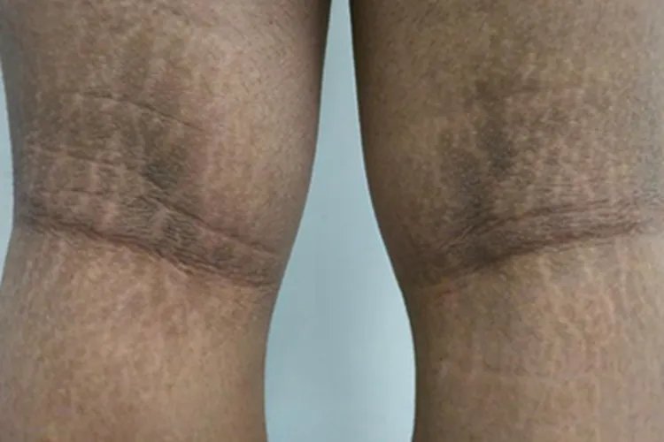 黑棘皮病长纹图片