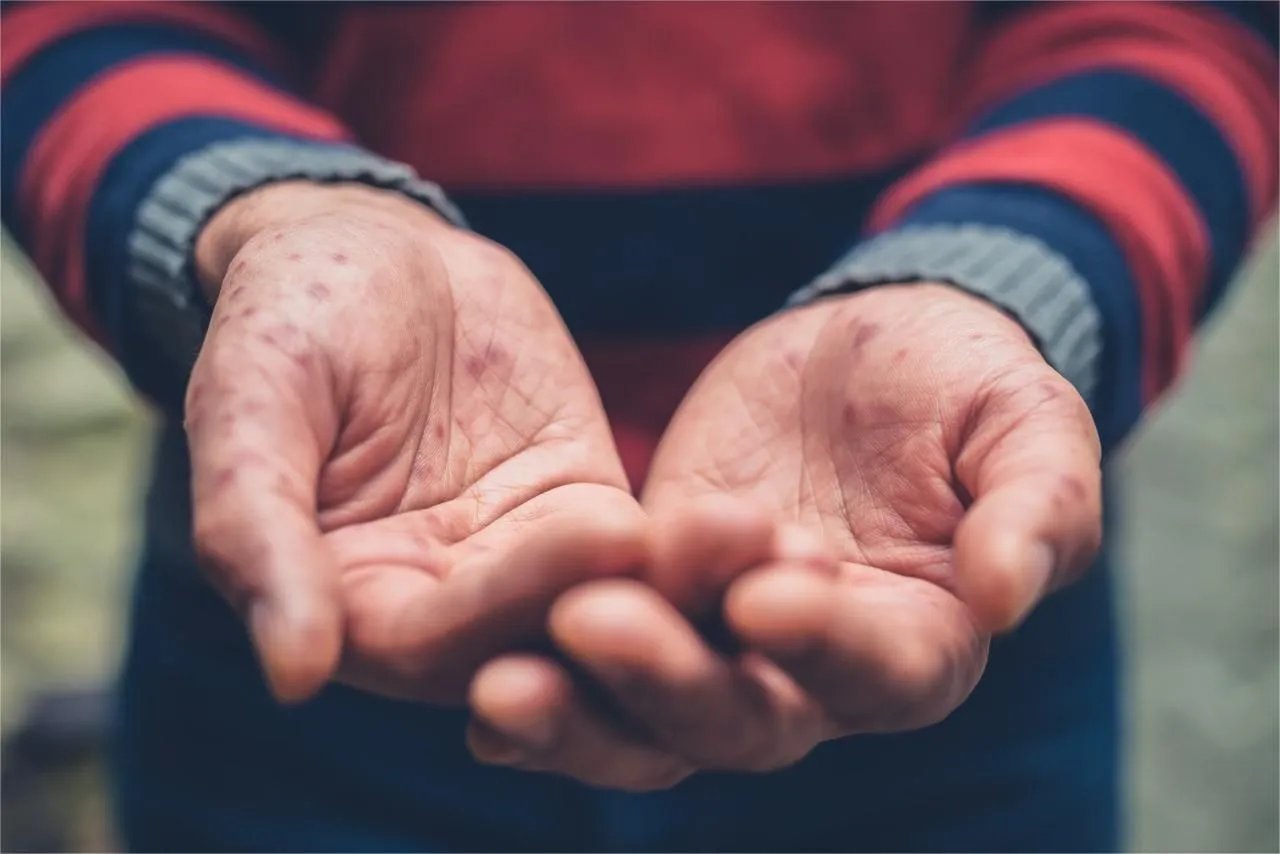 手上长雀斑图片