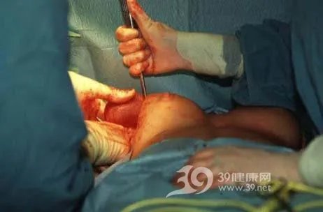 美女“隆胸手术”全程实录（组图）
