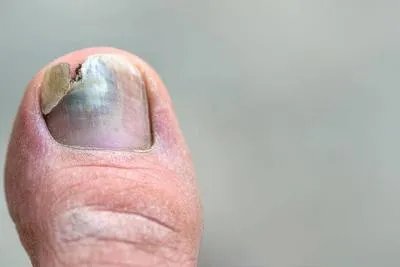 脚指甲砸伤后怎么处理