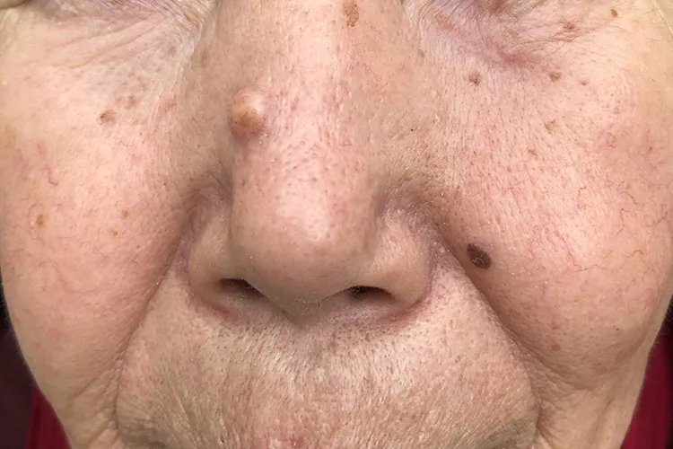 皮肤癌的症状与表现图片