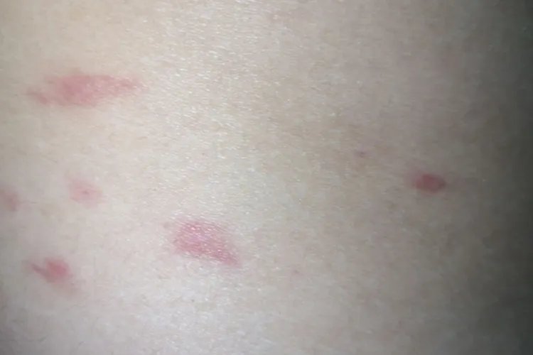 臭虫咬了的症状图片