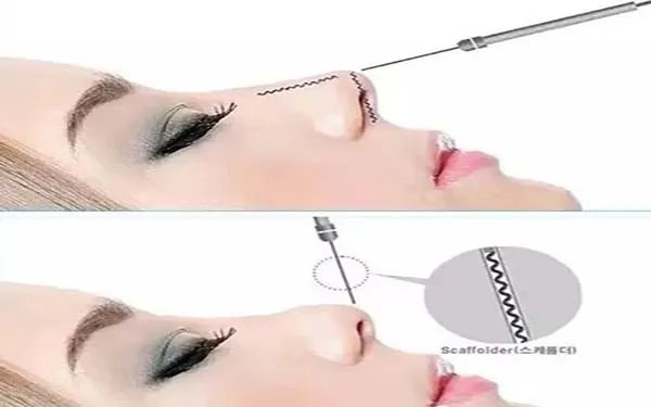 北京做耳软骨隆鼻到哪个医院好