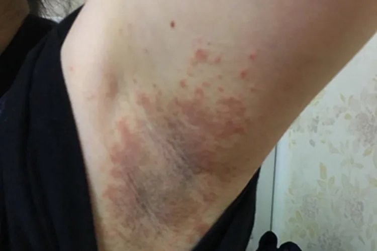 间擦疹腋窝丘疹图片
