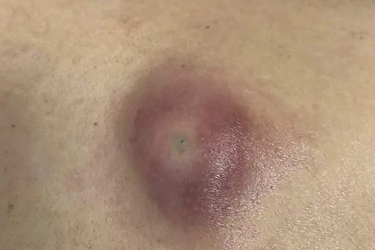 乳房上有个红疙瘩图片