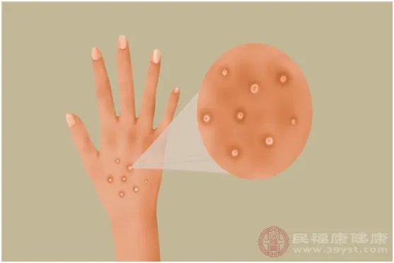 手被烫伤怎么办