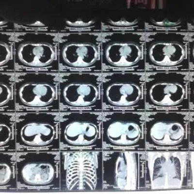 闭塞性细支气管炎能否治愈?