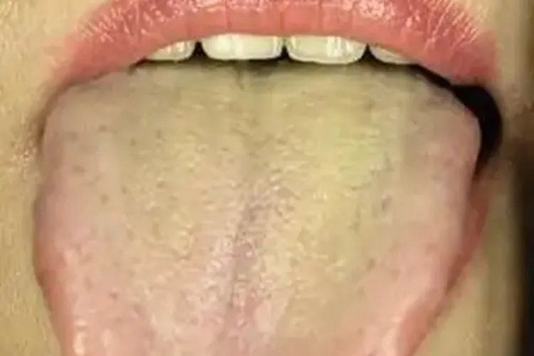 舌苔发黄厚腻图片