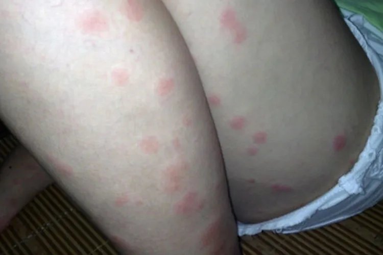 臭虫咬了的症状图片