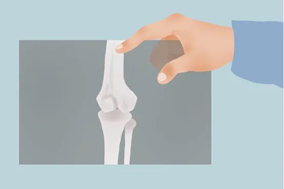 风湿关节炎怎么治疗比较好