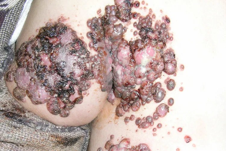 皮肤癌的症状与表现图片