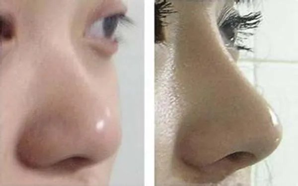 北京隆鼻大概多少钱