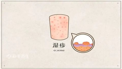 长湿疹怎么治疗