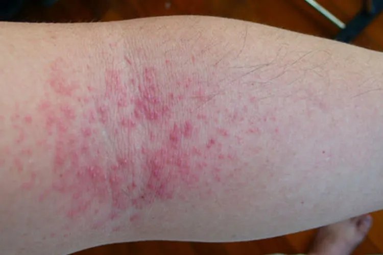 大人痱子症状图片