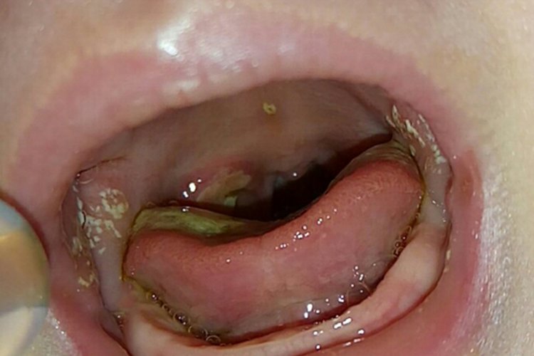 婴儿鹅口疮怎么治疗图片