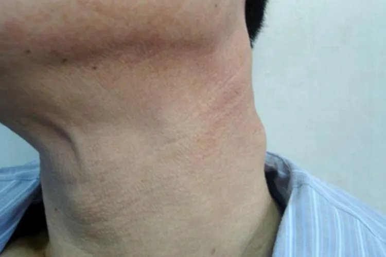 颈部长个包图片