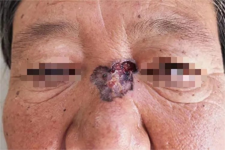 皮肤癌的症状与表现图片