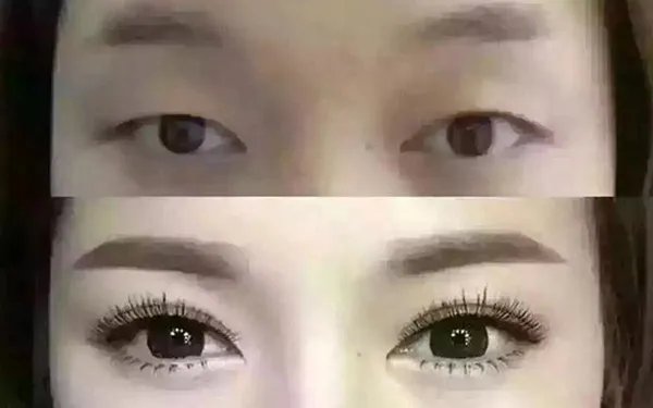 胶原蛋白隆鼻多少钱