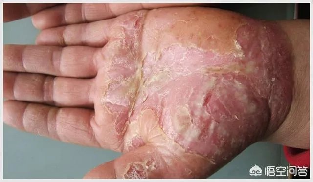 脚气的症状？