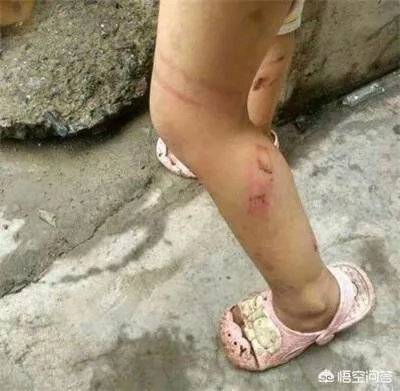 泉州11岁女孩疑似遭后妈毒打，伤痕累累, 你怎么看？