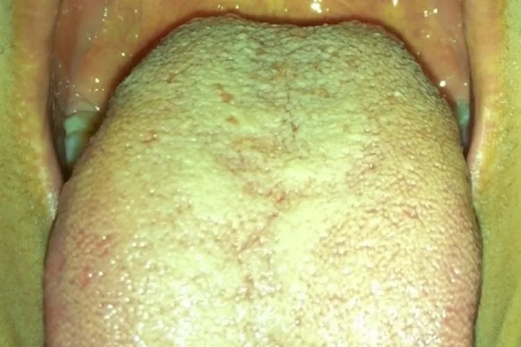 舌苔发黄厚腻图片