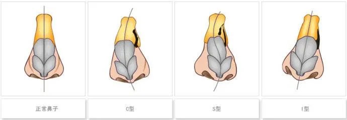 做歪鼻矫正术都了解吗？