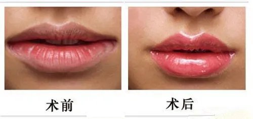 玻尿酸丰唇术多少钱呢