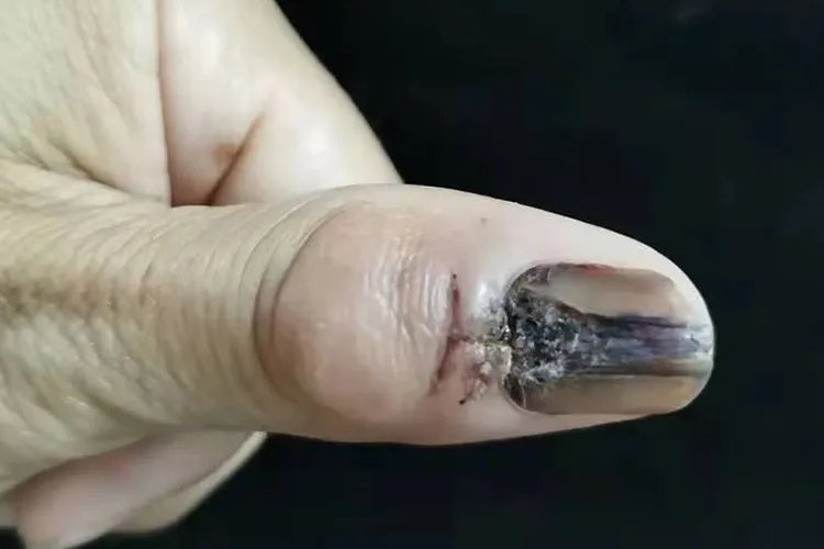 皮肤癌的症状与表现图片