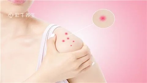 长湿疹怎么治疗